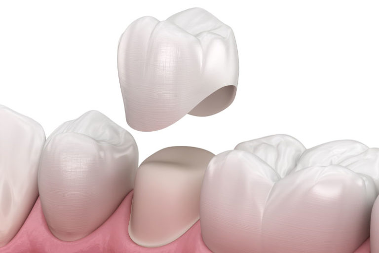 Solving Tooth Sensitivity Months After Crown Causes and Cures